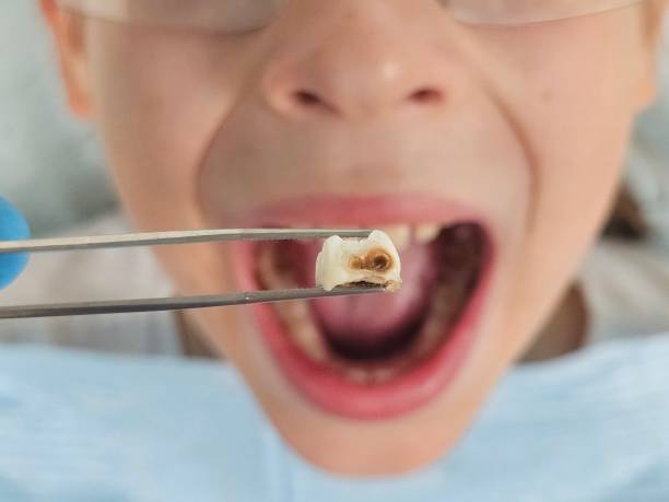 Best Emergency Dentist for Lost Fillings or Crowns in New Lebanon, OH